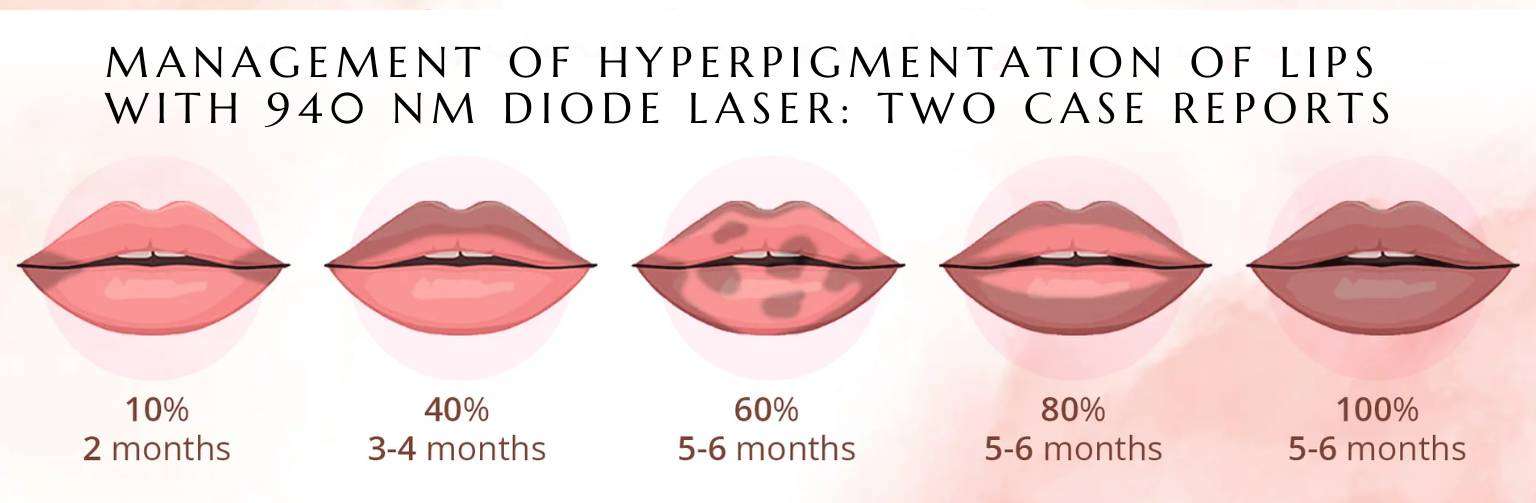 Management of Hyperpigmentation of Lips with 940 nm Diode Laser Two Case Reports