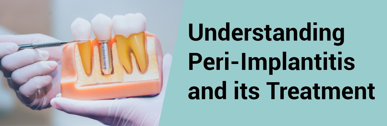 Understanding Peri-Implantitis and its Treatment