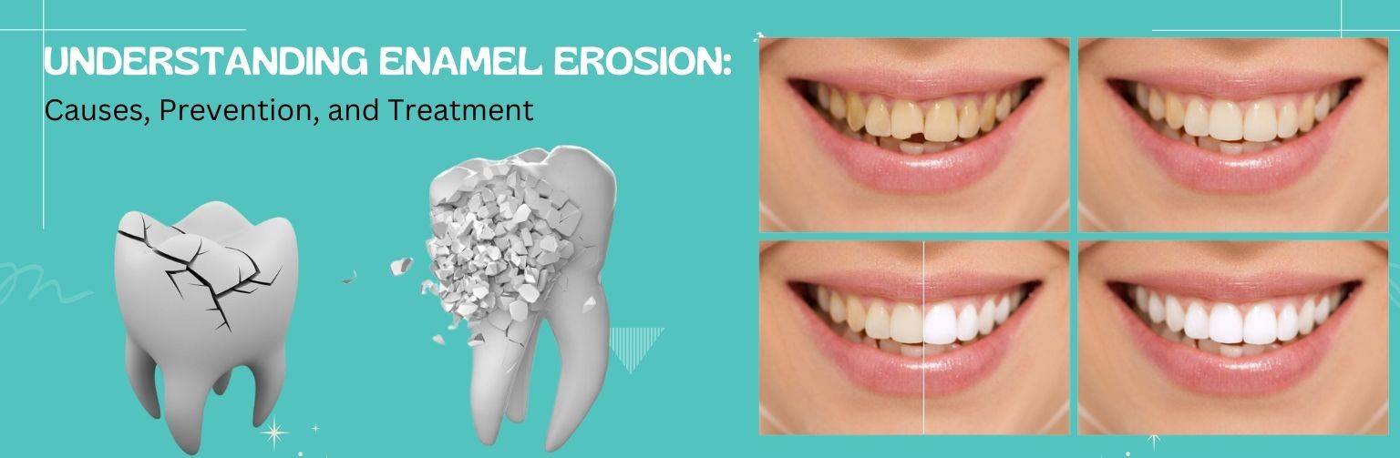 Understanding Enamel Erosion Causes, Prevention, and Treatment