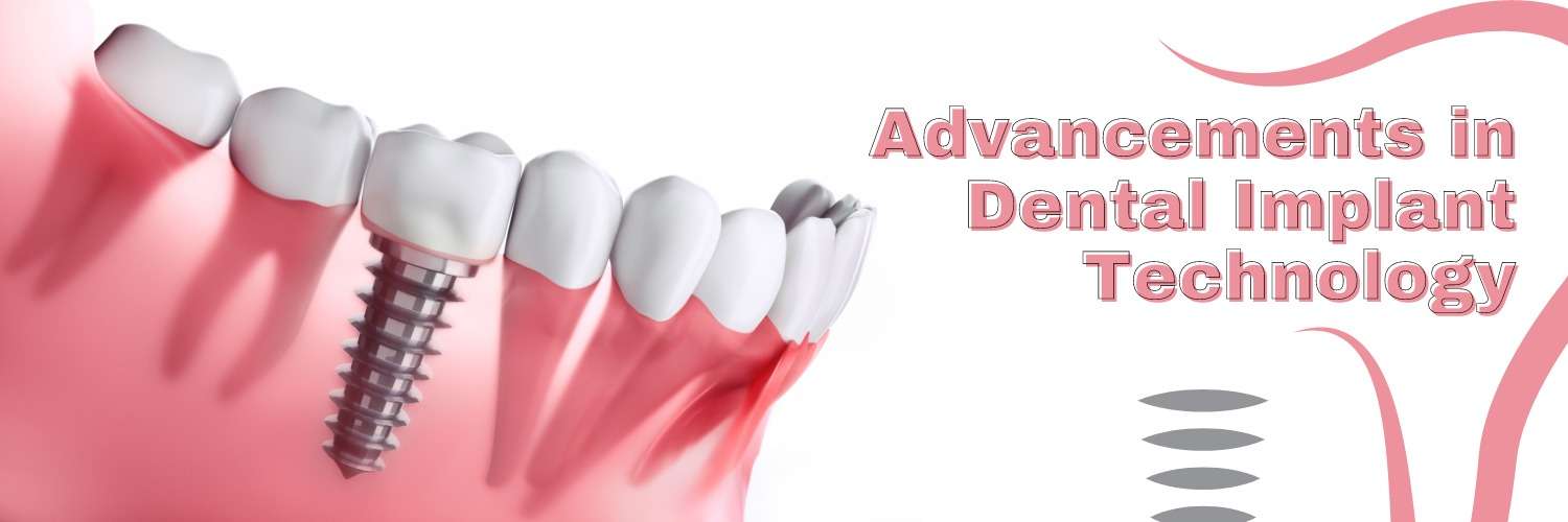 Advancements in Dental Implant Technology